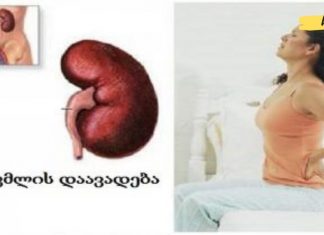 სიმპტომები, რომლებიც თირკმლის დაავადებაზე მეტყველებს. საჭირო ინფორმაციაა