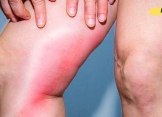 ორგანიზმში თრომბის საშიში ნიშნები, რომელსაც შეუძლია ადამიანის განადგურება