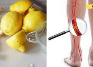 ლიმონისა და ნიორის შესანიშნავი კომბინაცია დაგეხმარებათ არტერიების გაწენდაში და აგაცილებთ გულის შეტევებს.