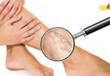 მოამზადეთ მალამო ვარიკოზული ვენებისთვის! შედეგი გაგაოცებთ