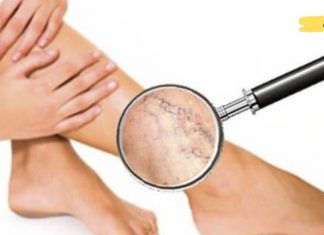 მოამზადეთ მალამო ვარიკოზული ვენებისთვის! შედეგი გაგაოცებთ