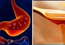 უმკურნალეთ გასტრიტს სახლის პირობებში. ეს აქამდე უნდა გამეკეთებინა