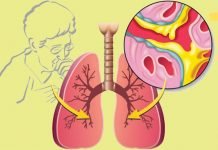 ძლიერი საშუალება ხველისა და ბრონქიტის სამკურნალოდ, ნახველის სწრაფად ამოღების მიზნით