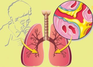 ძლიერი საშუალება ხველისა და ბრონქიტის სამკურნალოდ, ნახველის სწრაფად ამოღების მიზნით