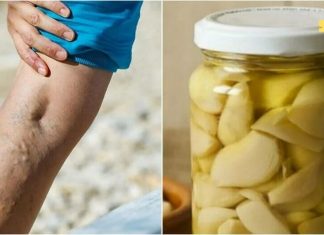 ნიორი ხელს უშლის ვარიკოზული ვენების წარმოქმნას. რეცეპტი იხილეთ სტატიაში!