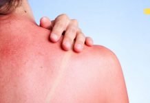 როგორ მოვუაროთ მზისგან დამწვარ კანს? ეს ნამდვილად დაგეხმარებათ