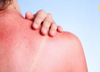 როგორ მოვუაროთ მზისგან დამწვარ კანს? ეს ნამდვილად დაგეხმარებათ