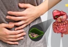 ამ მეთოდით ყველაზე სწრაფად და უმტკივნეულოდ შეძლებთ მოიშოროთ ნაღვლის ბუშტში არსებული ქვები!