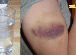 როგორ ვუმკურნალოთ სისხლჩაქცევებს სუფრის მარილის დახმარებით? ეფექტური მეთოდია!!.