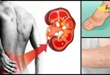 თირკმლების დაზიანების მაფრთხილებელი ნიშნები, რომელთა უგულებელყოფა არაფრით არ შეიძლება!!.