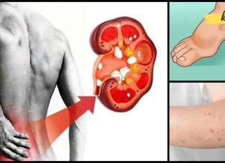 თირკმლების დაზიანების მაფრთხილებელი ნიშნები, რომელთა უგულებელყოფა არაფრით არ შეიძლება!!.