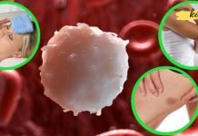 ლეიკემიის ადრეული ნიშნები. ამას დიდი ყურადღება უნდა მიაქციოთ!!