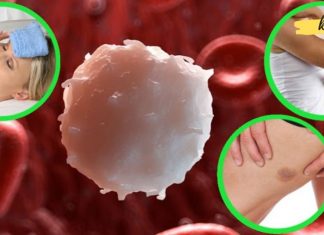 ლეიკემიის ადრეული ნიშნები. ამას დიდი ყურადღება უნდა მიაქციოთ!!