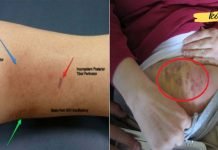 ფეხების, მუცლის და თავის ტვინის სისხლის შედედება შეიძლება ძალიან საშიში იყოს! აქ არის სიმპტომები, რომლებსაც უნდა გაუფრთხილდეთ!