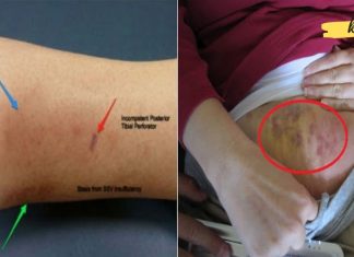 ფეხების, მუცლის და თავის ტვინის სისხლის შედედება შეიძლება ძალიან საშიში იყოს! აქ არის სიმპტომები, რომლებსაც უნდა გაუფრთხილდეთ!