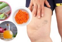 ბებიამ მასწავლა ეს საშუალება ვარიკოზული ვენების მოშორების მიზნით. ახლა ჩემი ფეხები მშვენივრად გამოიყურება!