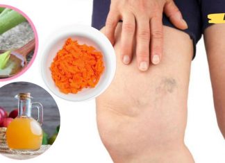 ბებიამ მასწავლა ეს საშუალება ვარიკოზული ვენების მოშორების მიზნით. ახლა ჩემი ფეხები მშვენივრად გამოიყურება!