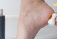 რატომ არის ძალიან სასარგებლო ღამით ქუსლების შეღებვა იოდით? ეს თქვენ უნდა იცოდეთ!