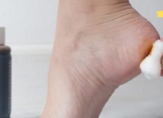 რატომ არის ძალიან სასარგებლო ღამით ქუსლების შეღებვა იოდით? ეს თქვენ უნდა იცოდეთ!