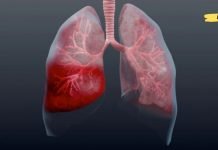 გაუფრთხილდით პნევმონიას! როგორ ამოვიცნოთ ადრე და როგორ გამოვჯანმრთელდეთ უფრო სწრაფად?