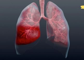 გაუფრთხილდით პნევმონიას! როგორ ამოვიცნოთ ადრე და როგორ გამოვჯანმრთელდეთ უფრო სწრაფად?