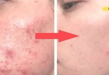 ამ 2 კომპონენტიანი საშუალებით მე სამუდამოდ მოვიშორე აკნე. დავისვენე!