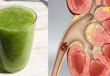 როგორ ამოვიღოთ თირკმელში არსებული ქვები მარტივად? ამაში ეს სასმელი დაგეხმარებათ