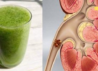 როგორ ამოვიღოთ თირკმელში არსებული ქვები მარტივად? ამაში ეს სასმელი დაგეხმარებათ