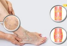 დაემშვიდობეთ ვარიკოზულ ვენებს, კალუსებს და გაბზარულ ქუსლებს სახლის პირობებში