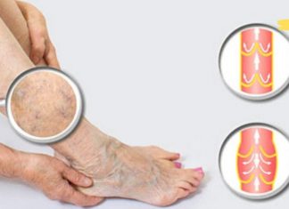 დაემშვიდობეთ ვარიკოზულ ვენებს, კალუსებს და გაბზარულ ქუსლებს სახლის პირობებში