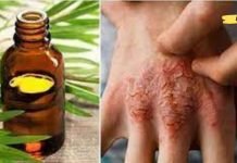 ჩაის ხის ზეთი ერთ-ერთი პირველი საშუალებაა ფსორიაზისა და ეგზემას დროს. რეცეპტი იხილეთ სტატიაში