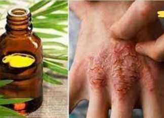 ჩაის ხის ზეთი ერთ-ერთი პირველი საშუალებაა ფსორიაზისა და ეგზემას დროს. რეცეპტი იხილეთ სტატიაში