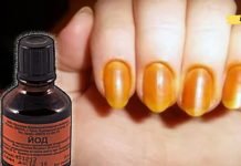 იოდი გაათავისუფლებს ფრჩხილის სოკოს: როგორ დავივიწყოთ დაავადება სულ რამდენიმე პროცედურაში?