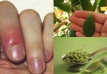 დაიდეთ ბარაქის ხის ფოთოლი დაჩირქებულ ადგილას და ის მთლიანად ამოიღებს ჩირქს! ბებიას რეცეპტია, რომელსაც ყველას ვურჩევ