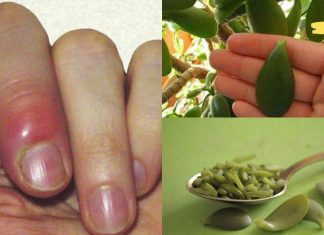 დაიდეთ ბარაქის ხის ფოთოლი დაჩირქებულ ადგილას და ის მთლიანად ამოიღებს ჩირქს! ბებიას რეცეპტია, რომელსაც ყველას ვურჩევ