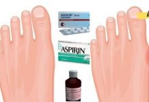 ანალგინი, ასპირინი და იოდი პოდაგრის სამკურნალოდ. სასწაულმოქმედი ნარევია!