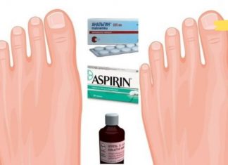 ანალგინი, ასპირინი და იოდი პოდაგრის სამკურნალოდ. სასწაულმოქმედი ნარევია!