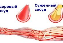 სუფთა სისხლძარღვები: 5 ოქროს რეცეპტი ჰერბალისტისგან. ათეროსკლეროზის მკურნალობა