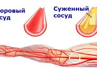 სუფთა სისხლძარღვები: 5 ოქროს რეცეპტი ჰერბალისტისგან. ათეროსკლეროზის მკურნალობა