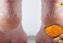 მოამზადეთ წამალი ლამაზი ქუსლებისთვის კურკუმით, ასპირინითა და ალკოჰოლით