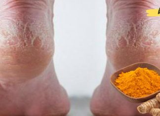 მოამზადეთ წამალი ლამაზი ქუსლებისთვის კურკუმით, ასპირინითა და ალკოჰოლით