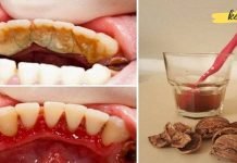 ეს ყველაზე სწრაფად წმენდს კბილებს ქვებისგან. ეფექტურია