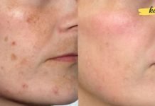 როგორ მოვიცილოთ ასაკობრივი ლაქები: საუკეთესო საშუალებები და მეთოდები