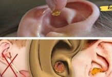 როგორ აღმოფხვრათ ჭარბი ყურის ცვილი, უსაფრთხო და სწრაფმოქმედი მეთოდები