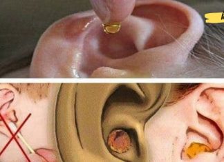 როგორ აღმოფხვრათ ჭარბი ყურის ცვილი, უსაფრთხო და სწრაფმოქმედი მეთოდები