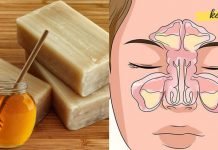 მალამო სინუსიტის სამკურნალოდ. რა საშინაო საშუალებები აღარ ვცადე – მხოლოდ ეს მალამო დამეხმარა!