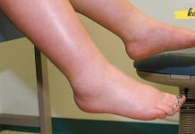 როგორ ვებრძოლოთ შეშუპებას: 6 სასარგებლო რჩევა ამ პრობლემის მოსაგვარებლად