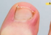 როგორ უნდა უმკურნალოთ ჩაბრუნებულ ფრჩხილს? სასარგებლო და ეფექტური რჩევები