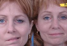 7 სიმპტომი, რომელიც ქალებში ინსულტის ამოცნობაში დაგეხმარებათ