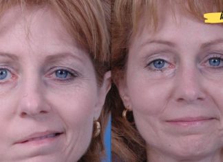 7 სიმპტომი, რომელიც ქალებში ინსულტის ამოცნობაში დაგეხმარებათ